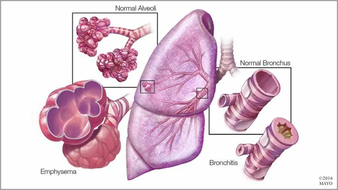 Le rôle de la béclométhasone dans la gestion de la maladie pulmonaire obstructive chronique (MPOC)